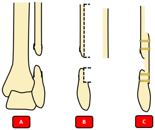 Subperiosteal technique for fibular exposure, graft prep in front-posterior view, restoring normal malleolus length and position technique steps.