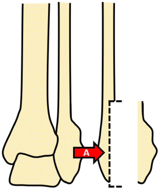 Schematic diagram illustrates surgical modification step A on right foot arch area to correct flatfoot condition.