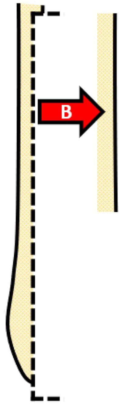Schematic figure showing a surgical modification procedure with a red arrow labeled B.