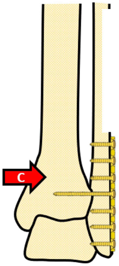 Schematic figure showing step C of a surgical modification on a leg. An arrow labeled with the letter C pointing to the foot’s surgical area marked with yellow pins.