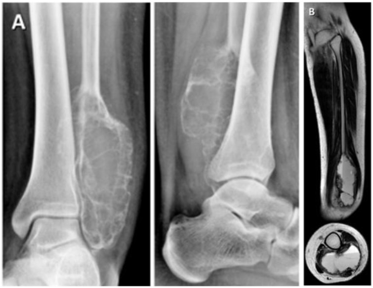 A series of images: Lytic and effusive lesion on the right malleolus, an MRI with a sagittal view (1), and a sagittal view (2).