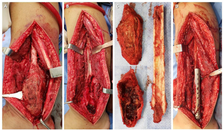 A surgical case showing lesions in the knee (dissection), distal fibula bed after resection, graft from proximal fibula, and final post-graft fixation (A-D).