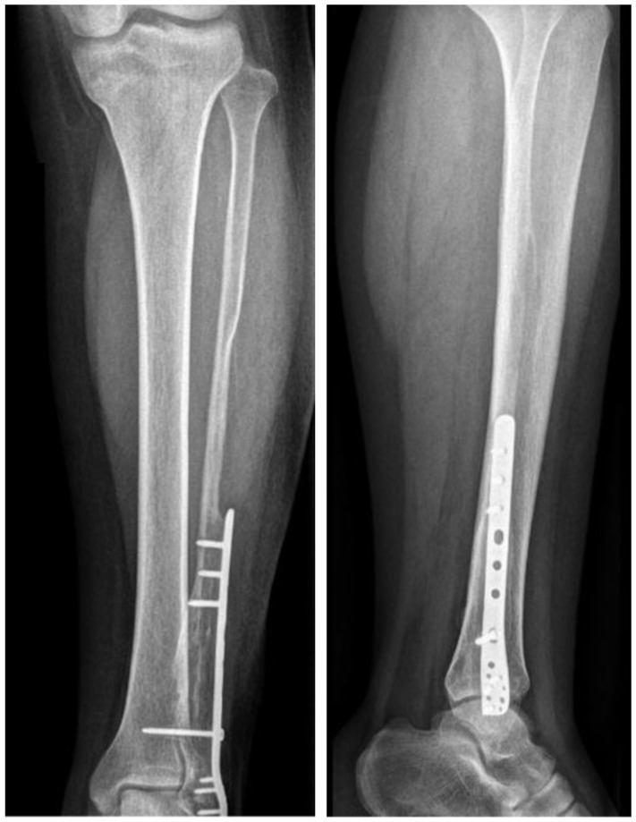 Ankle radiograph post-surgery showing proper alignment, no signs of recurrence, and donor area remodeling after six months.