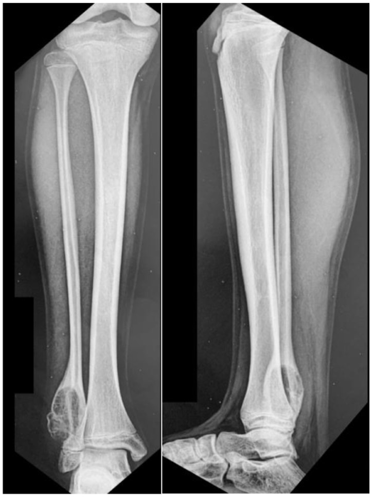 Initial radiograph showing a lytic, insufflating lesion in the distal metaphysis of the fibula without involvement of the epiphysis.
