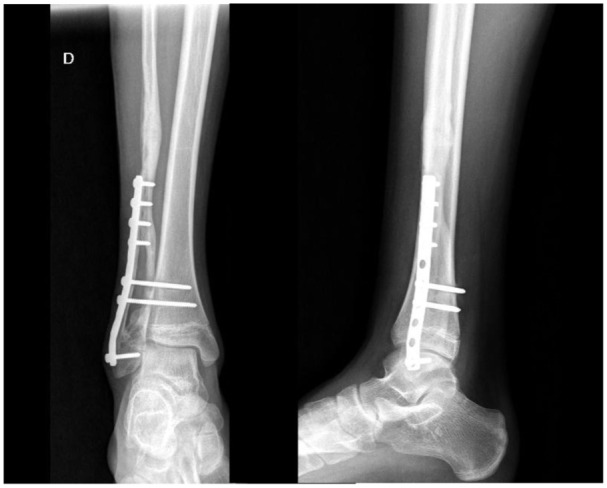 An ankle radiograph at six months post-operation shows good alignment, no local recurrence signs, donor area remodeling.